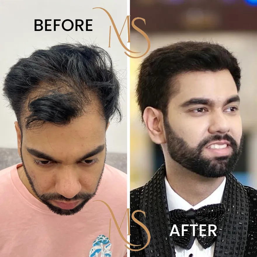Hair Transplant Specialist Delhi